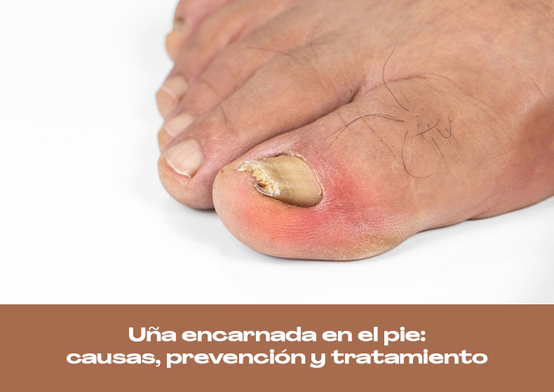 Uña encarnada en el pie, uñero