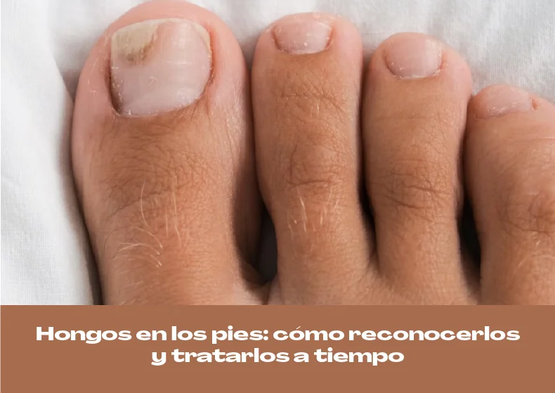 Hongos en los pies: cómo reconocerlos y tratarlos a tiempo