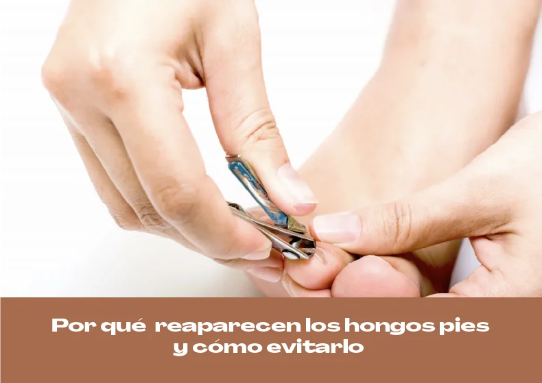 Por qué reaparecen los hongos en los pies y cómo evitarlos definitivamente