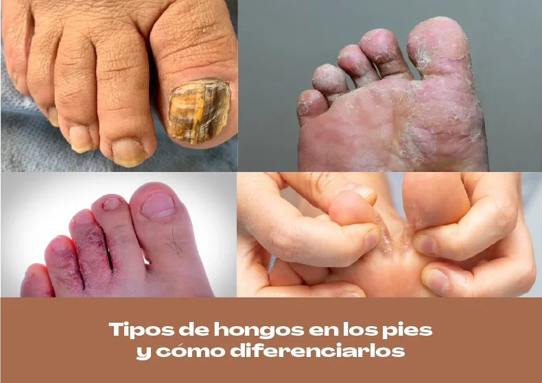 Tipos de hongos en los pies y cómo diferenciarlos: guía completa