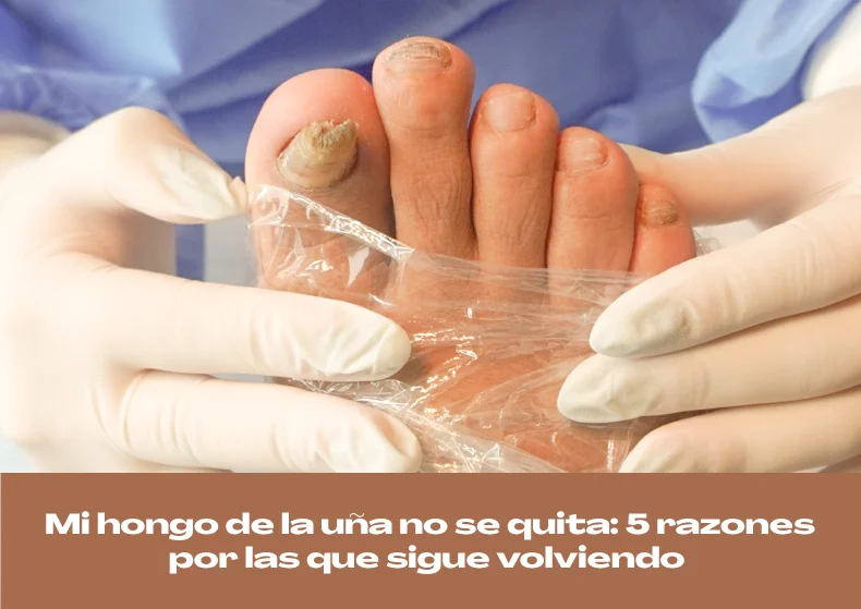 Mi hongo de la uña no se quita: 5 razones por las que vuelve