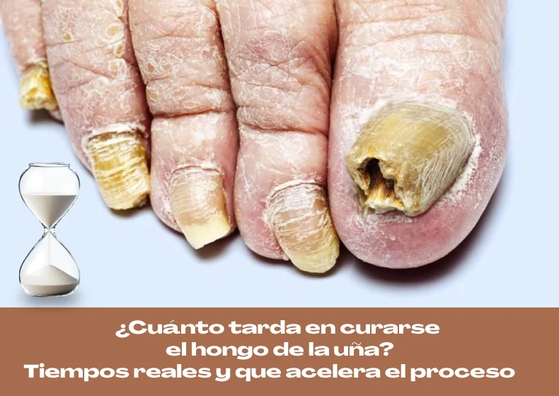 ¿Cuánto tarda en curarse el hongo de la uña? Tiempos y consejos