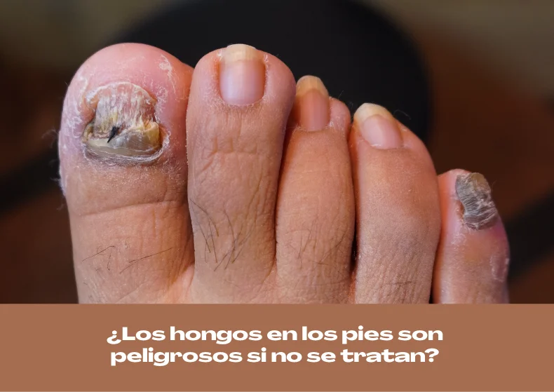 ¿Los hongos en los pies son peligrosos si no se tratan?