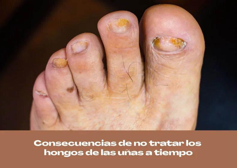 Consecuencias de no tratar los hongos en las uñas a tiempo