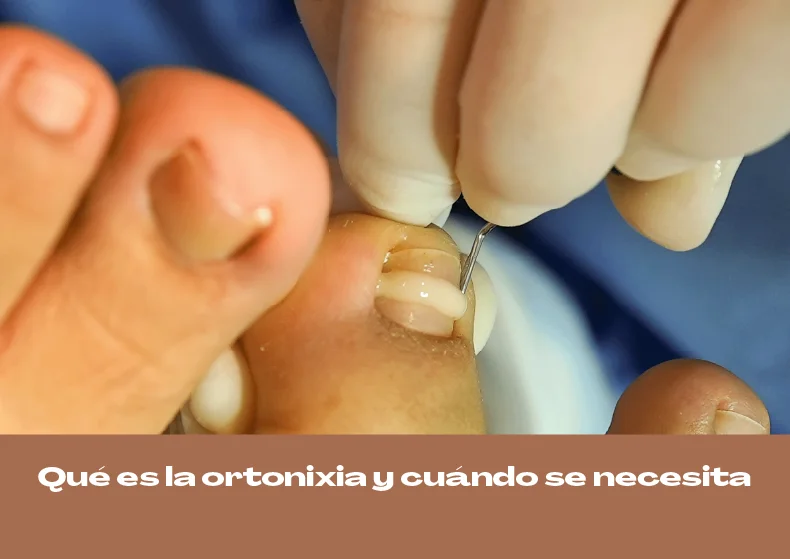Qué es la ortonixia y cuándo se necesita