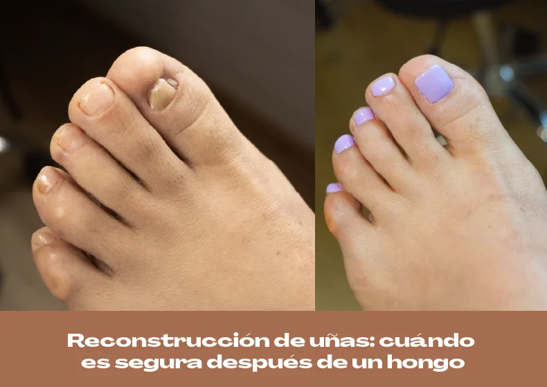 Reconstrucción de uñas después de hongos: cuándo es segura