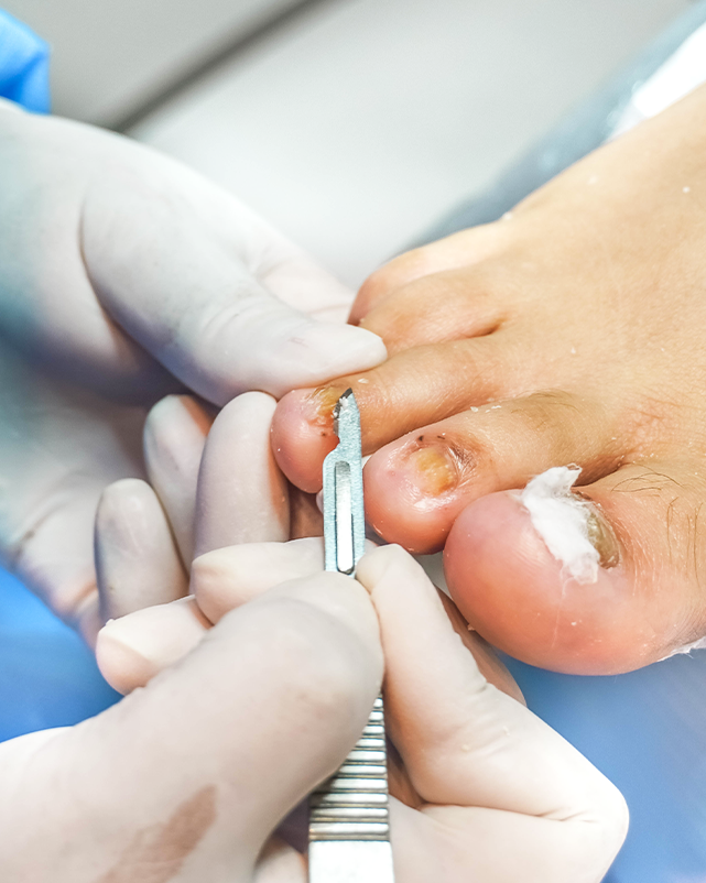 Podologia-para-pie-diabetico