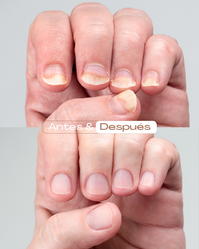 Profilaxis-ungueal-para-manos